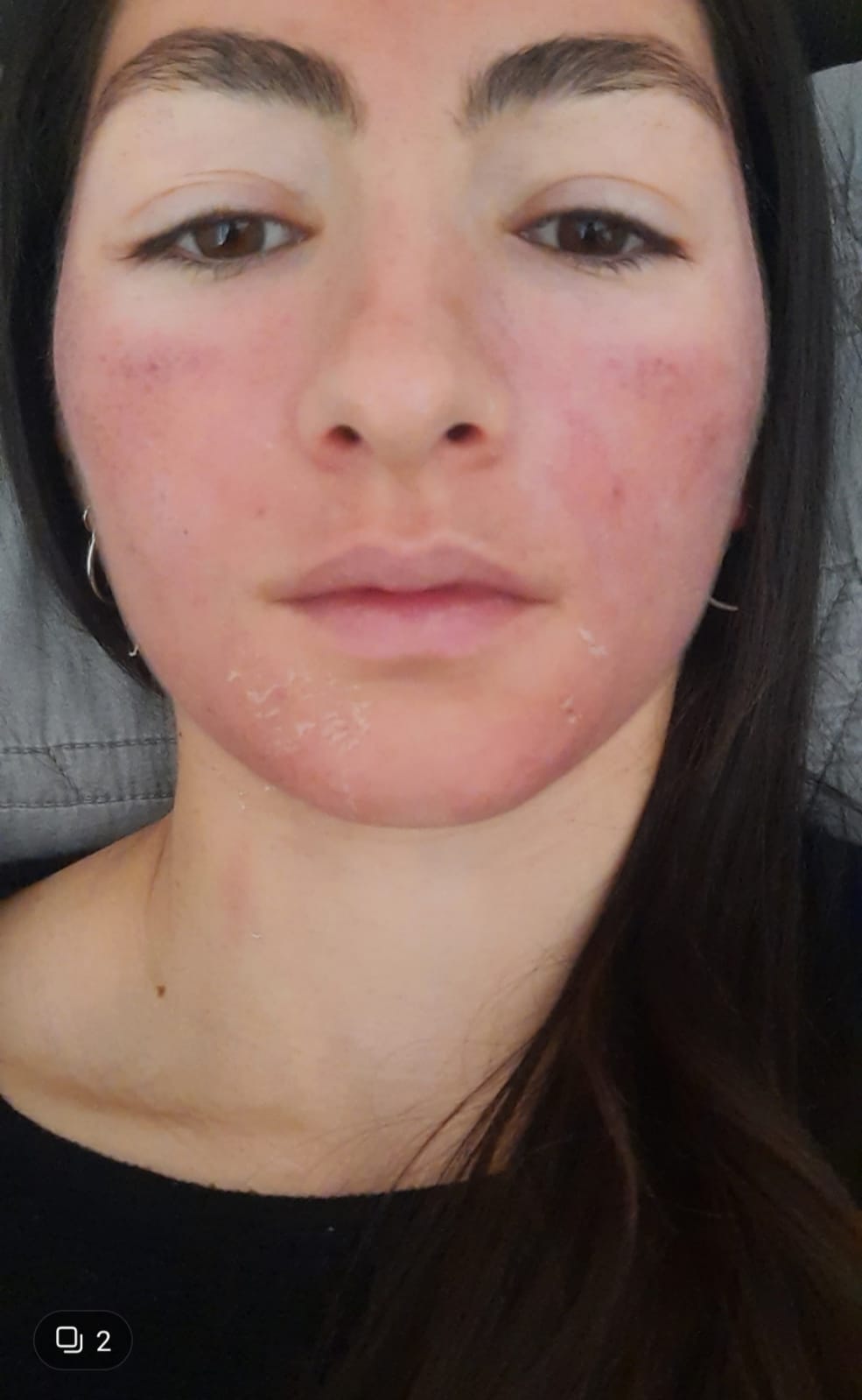 Tatiana antes: rostro frontal, piel con brotes activos.